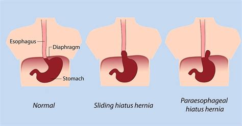 Hernia Symptoms Abdomen Hiatal Hernia Types Of Hernia Treatment