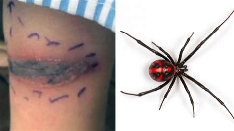 What Is A Black Widow Bite Look Like What Does A Spider Bite Look