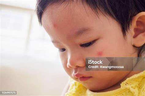 곤충 물린에 의해 알레르기 붉은 반점 얼굴 원인으로 귀여운 작은 아시아 여자 유아에 대한 스톡 사진 및 기타 이미지 유아