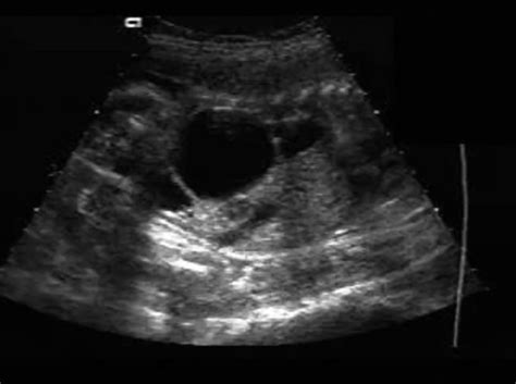 Ovarian Cyst Ultrasoundpaedia