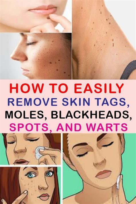 how to easily remove skin tags moles blackheads spots and warts with natural remedies