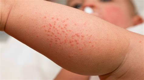 Heat Rash Prickly Heat Miliaria What To Expect