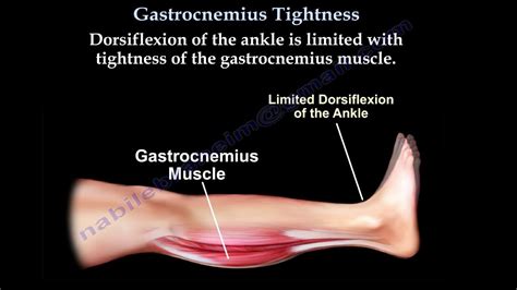 Gastrocnemius Tightness - Everything You Need To Know - Dr. Nabil