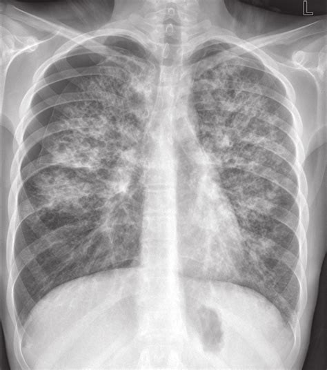 Chest X Ray Showing Bilateral Pneumothorax And Bilateral Interstitial