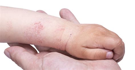 Dermatite Atopica Nei Bambini Dermatologo A Milano E Aosta Dr Morelli
