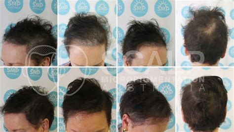 Scalp Micropigmentation Repair - SMP Australia