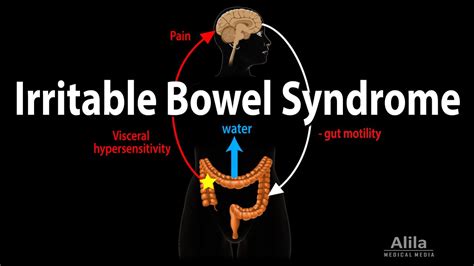 Irritable Bowel Syndrome Pathophysiology Symptoms Causes Diagnosis