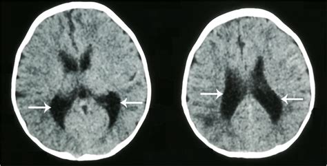 Head Ct Scan Demonstrating Enlarged Lateral Ventricles With