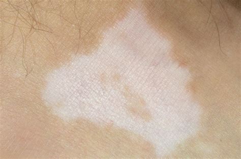 Light Skin Discoloration On Legs