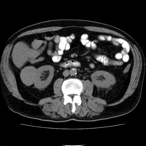 Renal Cell Carcinoma X Ray