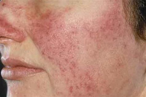 Dry Patches On Face Flaky Peeling Red White Pictures Causes Get