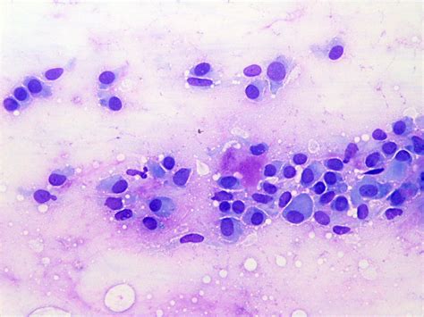 Pathology Outlines Pleomorphic Adenoma