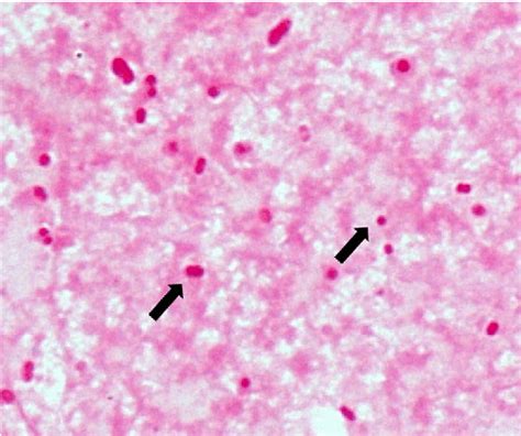 Pdf Severe Community Acquired Pneumonia Caused By Acinetobacter