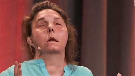 New Hampshire Woman Becomes First American To Undergo Two Face