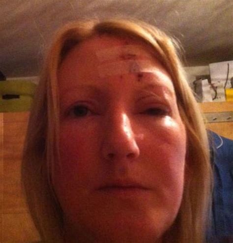 Woman Reveals Nasty Facial Injuries After Cat Attack Leaves Her Blind