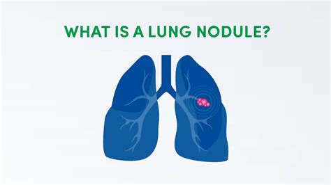 Lung Nodules Important Facts And Figures Infographic