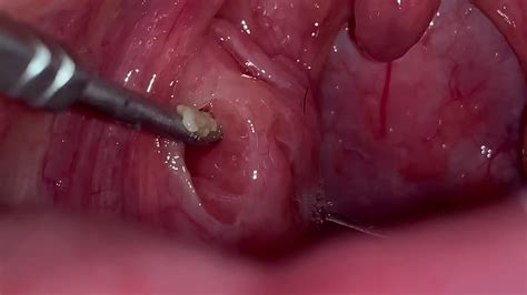 A Couple Of Gigantic Tonsil Stones Youtube