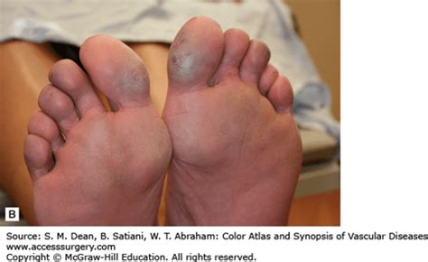Immersion Foot Syndrome Thoracic Key