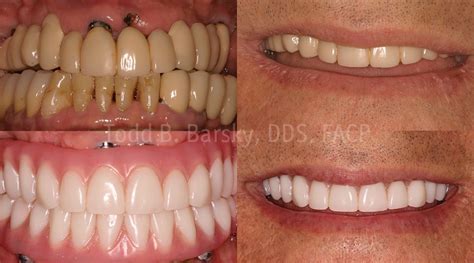 All On 4 Dental Implants Before And After