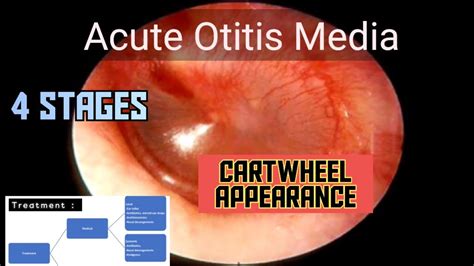 acute otitis media etiology signs stages treatment ent medu youtube