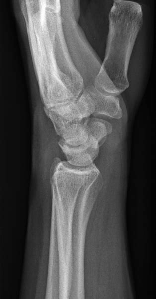 What Constitutes A True Lateral Wrist Position Wikiradiography