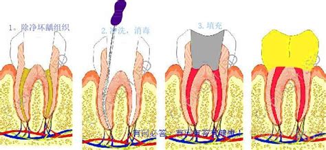 牙髓炎有哪些好的治疗方法 成都极光口腔医院