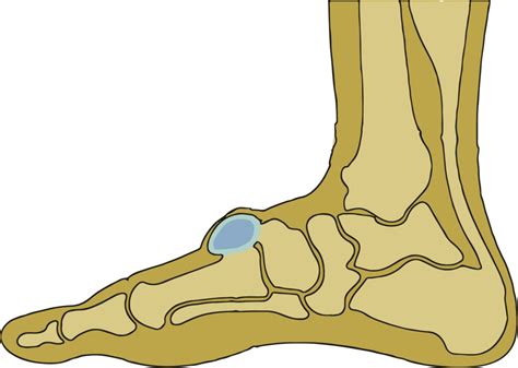 What About Ganglion Cysts On The Foot Ganglion Cysts Information