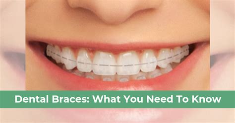 Dental Braces What You Need To Know Teeth And Braces Clinic Indore