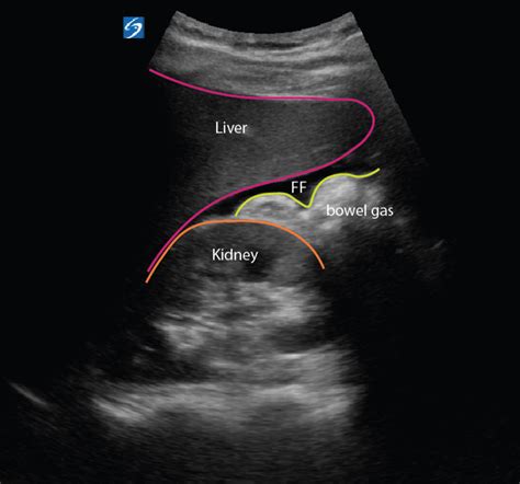 Ruptured Spleen Critical Care Sonography
