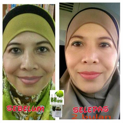 Puan hayati berumur 48 tahun tahun mengalami sinus yang teruk sehingga air mata keluar. Testimoni XANZWHITE : Menegangkan kulit yang kendur ...