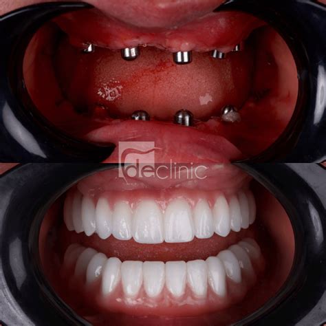 All On Six Implants Dental Excellence Turkey Dental Clinic In