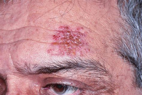 Shingles Rash On The Head Photograph By Dr P Marazzi Science Photo