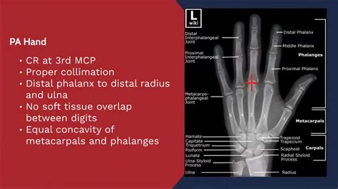X Ray Positioning Evaluation Pa Hand Youtube