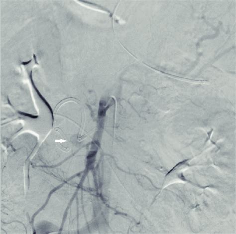 Superior Mesenteric Artery Sma Angiogram Showing Extravasation Thick