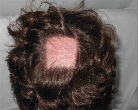 Sharply Defined Square Alopecia In The Occipital Region With Almost