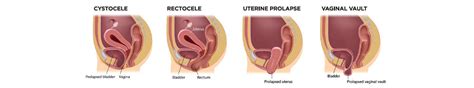 Pelvic Organ Prolapse Physical Therapy Treatment In New York City