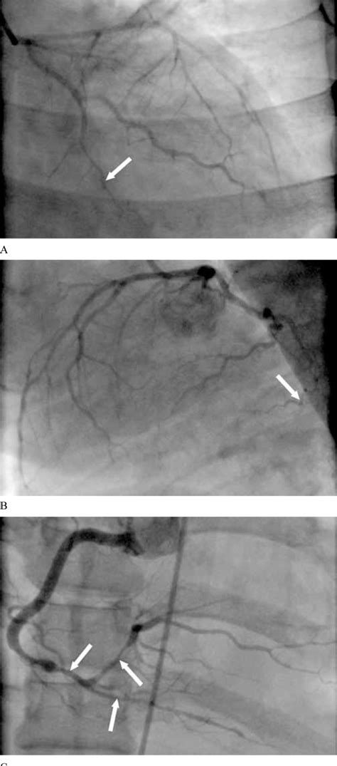 Coronary Catheterization In The Seventh Day Of Hospitalization A And B