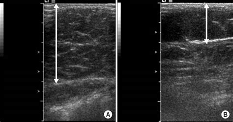 Abdominal Subcutaneous Fat Thickness Measured By Ultrasonography