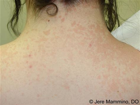 Tinea Versicolor American Osteopathic College Of Dermatology Aocd