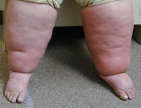 A 73 Year Old With Lower Extremity Edema A Comprehensive