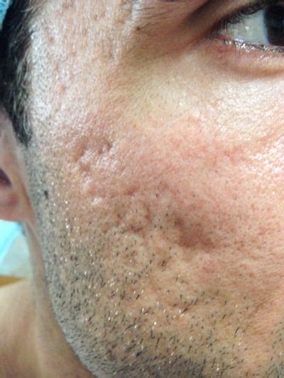 Acne Scarring Treated With Subcision And Fat Graftinglaser Photo From