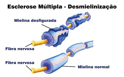 Esclerose MÚltipla Clínica Dr Rocha