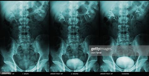 Xray Of Urinary Tract High Res Stock Photo Getty Images