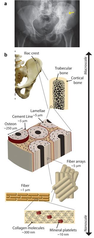 Hierarchical Structure Of Bone A Radiologic Signs Of Pdb In The Area