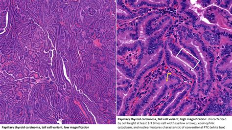 Variants Of Papillary Thyroid Carcinoma Microcarcinoma Tall Cell