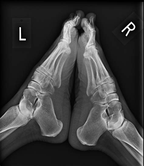 Foot And Ankle Problems By Dr Richard Blake Hallux Limitusrigidus