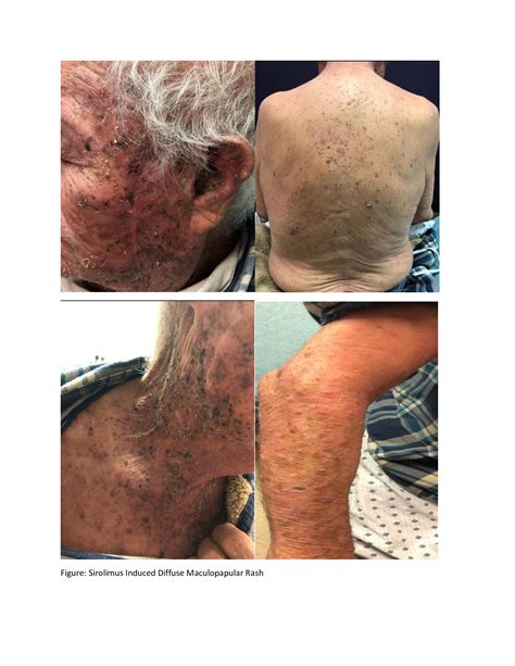 The Diffuse Pruritic Maculopapular Rash In A Kidney Transplant Patient