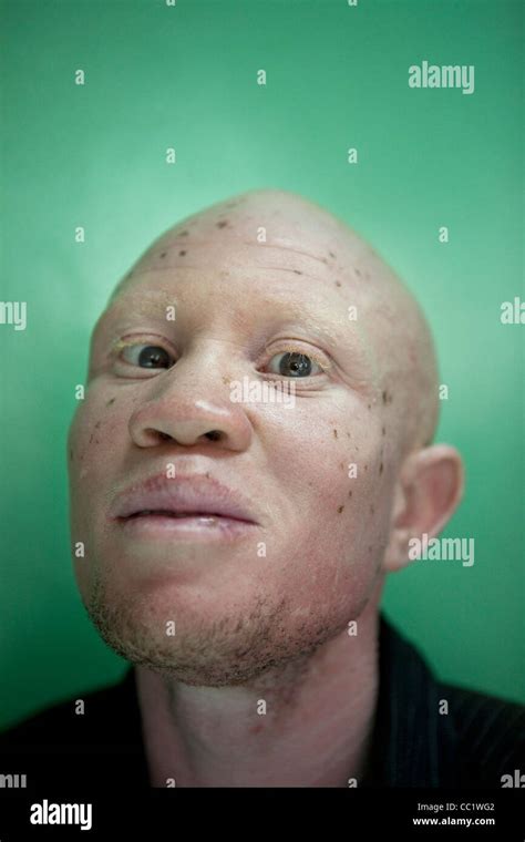 African Albino Man Hi Res Stock Photography And Images Alamy