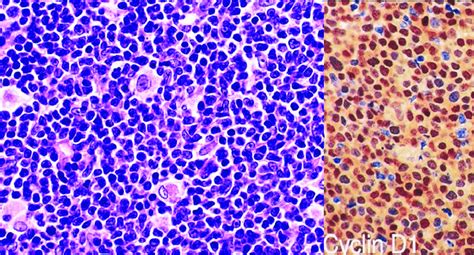 Mantle Cell Lymphoma Showing Cyclin D1 Positivity Download
