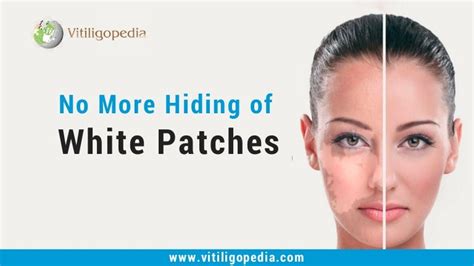 Vitiligo Treatment In India Vitiligo Symptoms Delhi